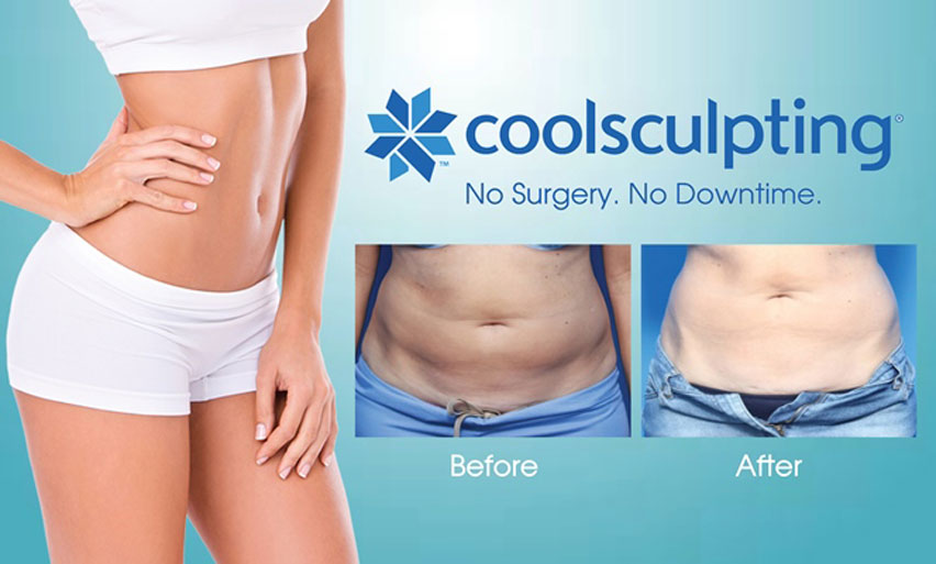 Cool Sculpting in Tampa FL